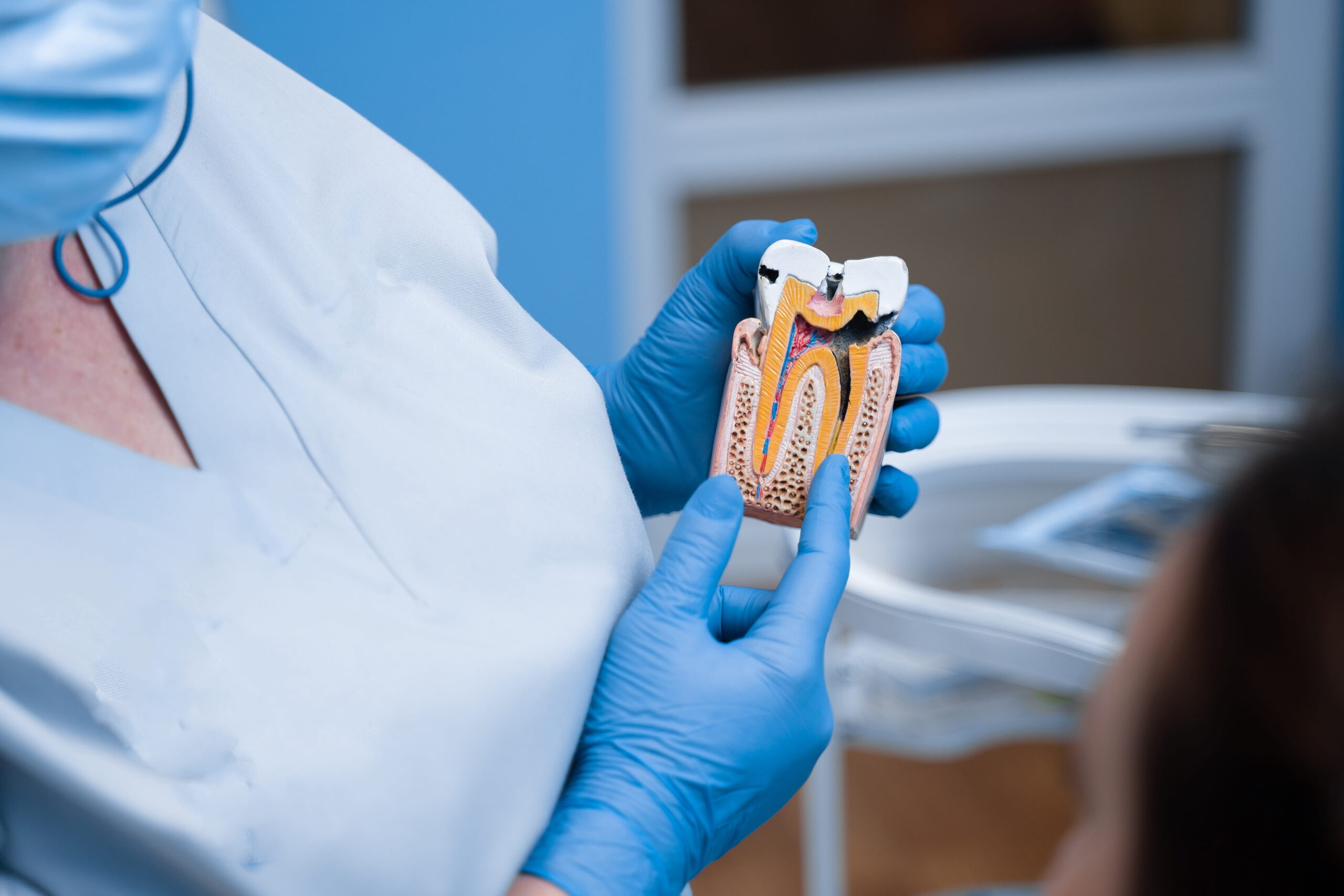 Dental model showing structure of a tooth with caries for patient education